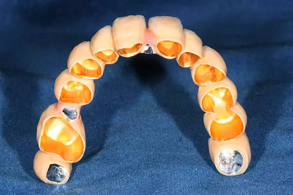 Dental Implantat